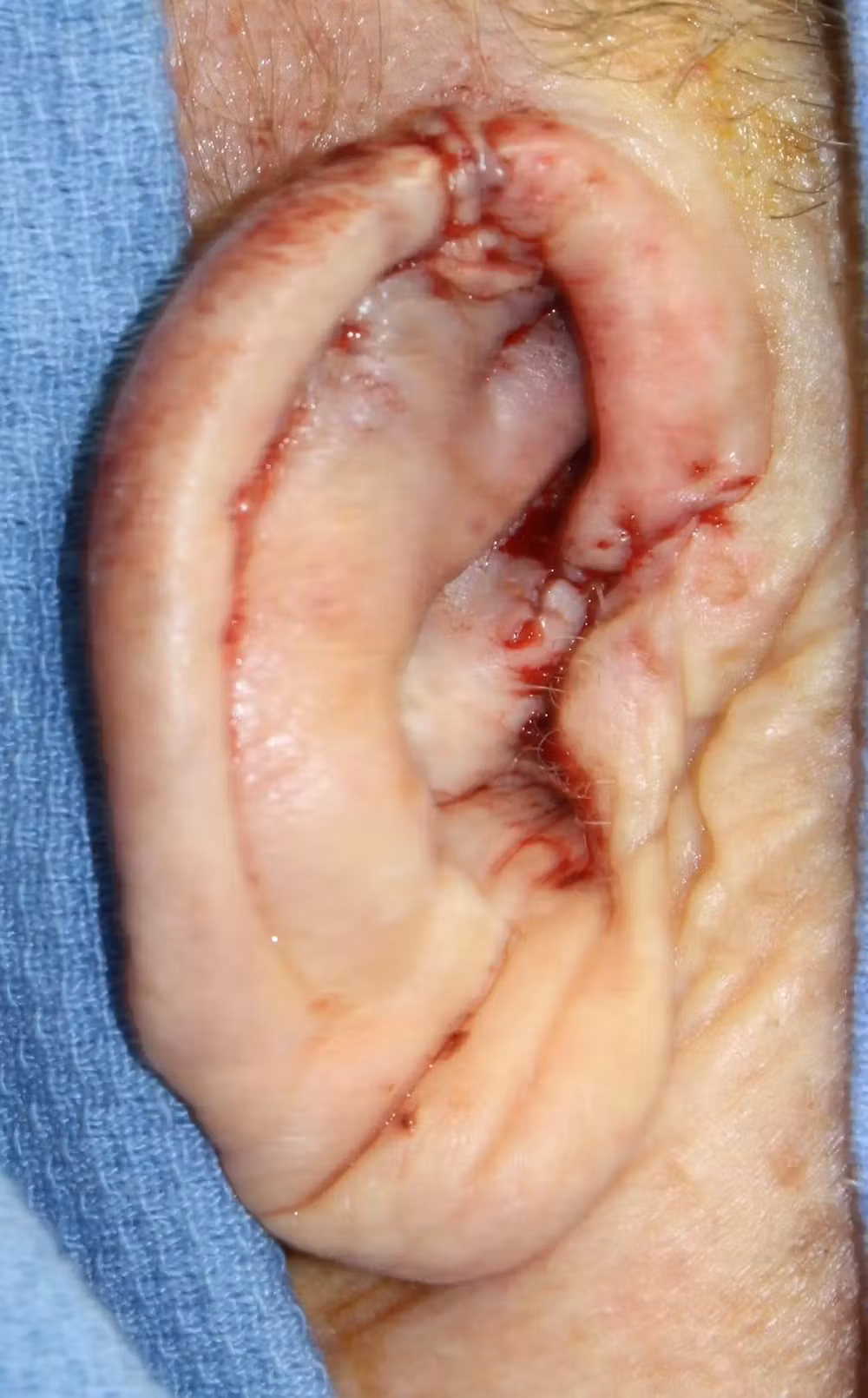 1596659120-right-ear-reconstruction-with-antia-buch-flap-dr-mussman-jpg