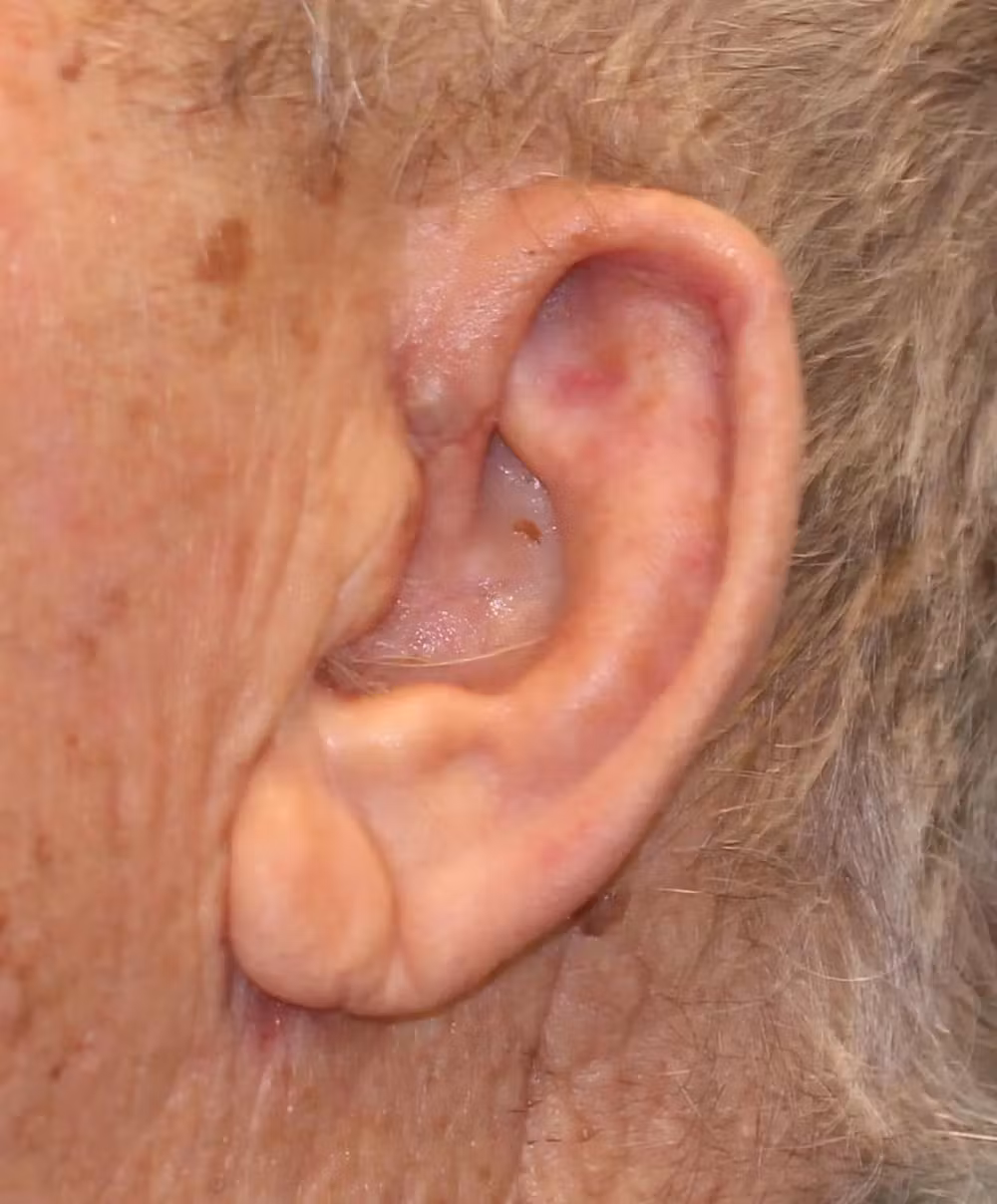 1596659139-left-ear-reconstruction-with-antia-buch-flap-two-dr-mussman-jpg