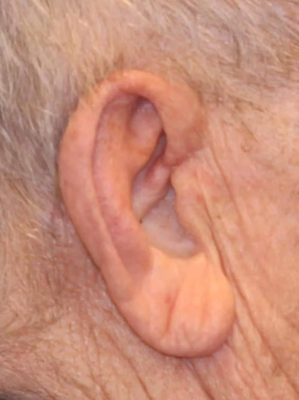 1596659163-right-ear-basal-cell-cancer-post-reconstruction-two-dr-mussman-jpg