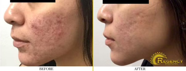 Acne Treatment 1.1