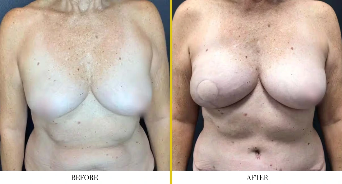 BREAST RECONSTRUCTION (1)