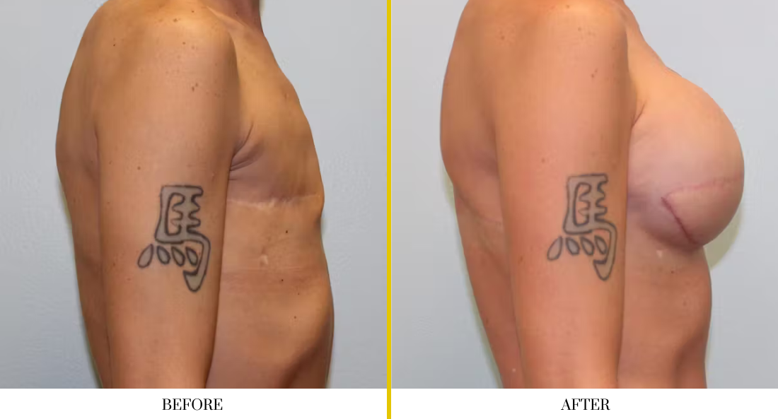 BREAST RECONSTRUCTION (10)