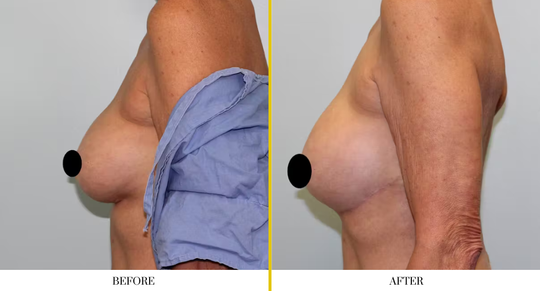 BREAST RECONSTRUCTION (12)