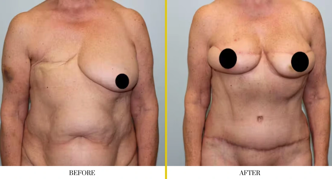 BREAST RECONSTRUCTION (14)
