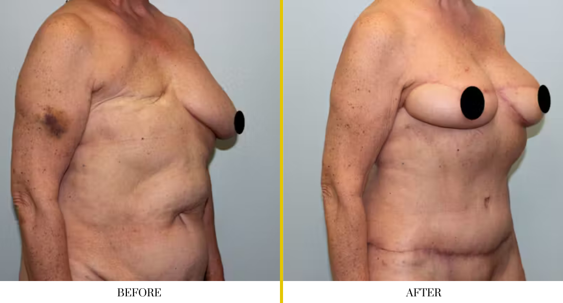 BREAST RECONSTRUCTION (15)