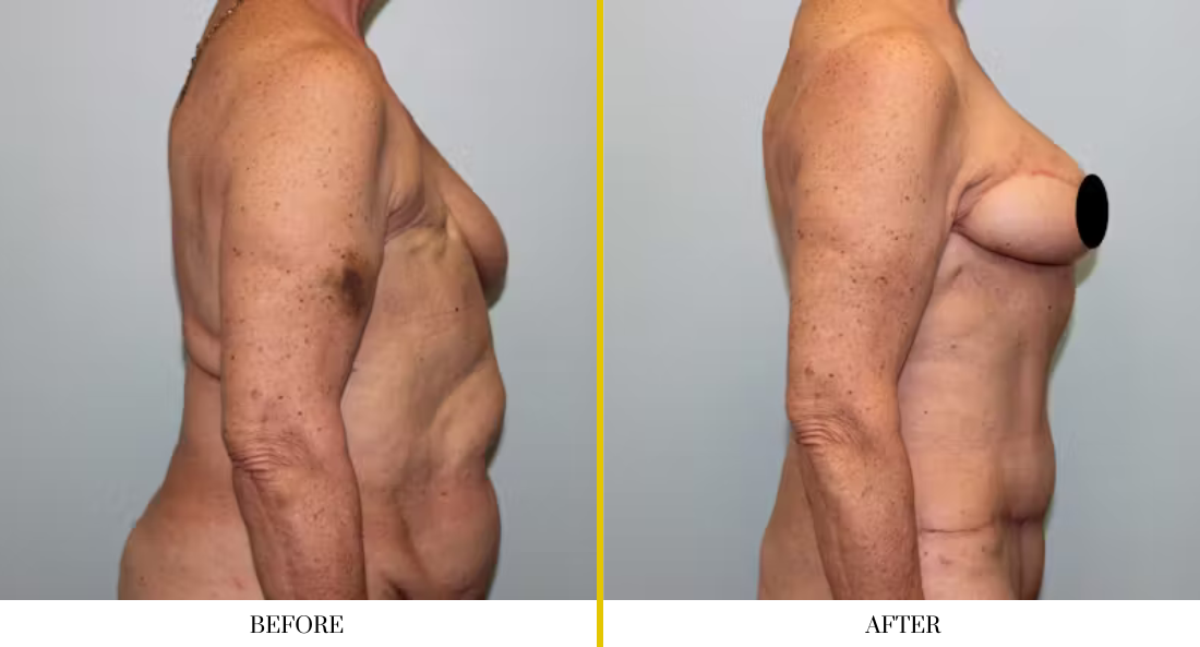BREAST RECONSTRUCTION (16)