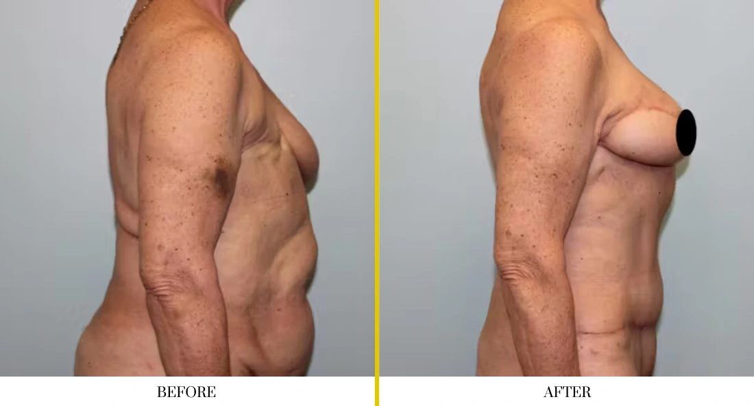 BREAST RECONSTRUCTION (16)