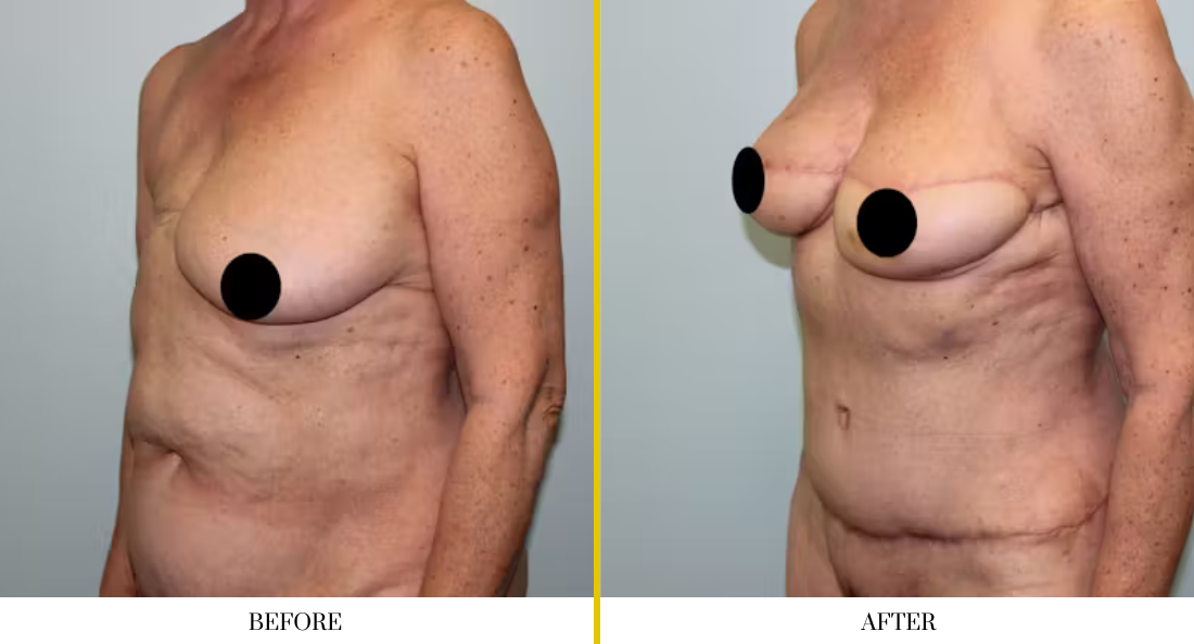 BREAST RECONSTRUCTION (17)