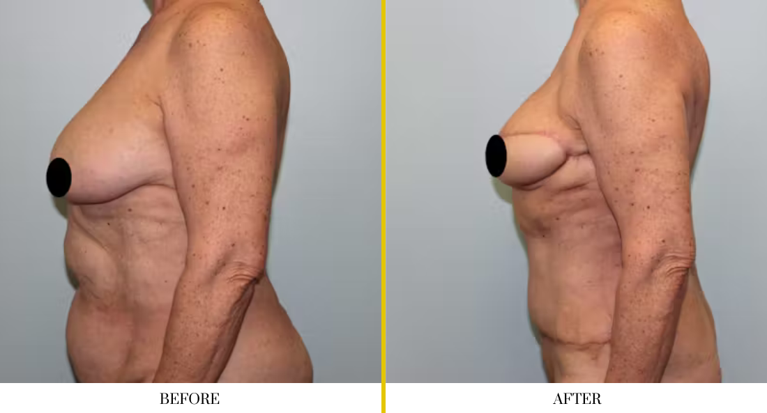 BREAST RECONSTRUCTION (18)