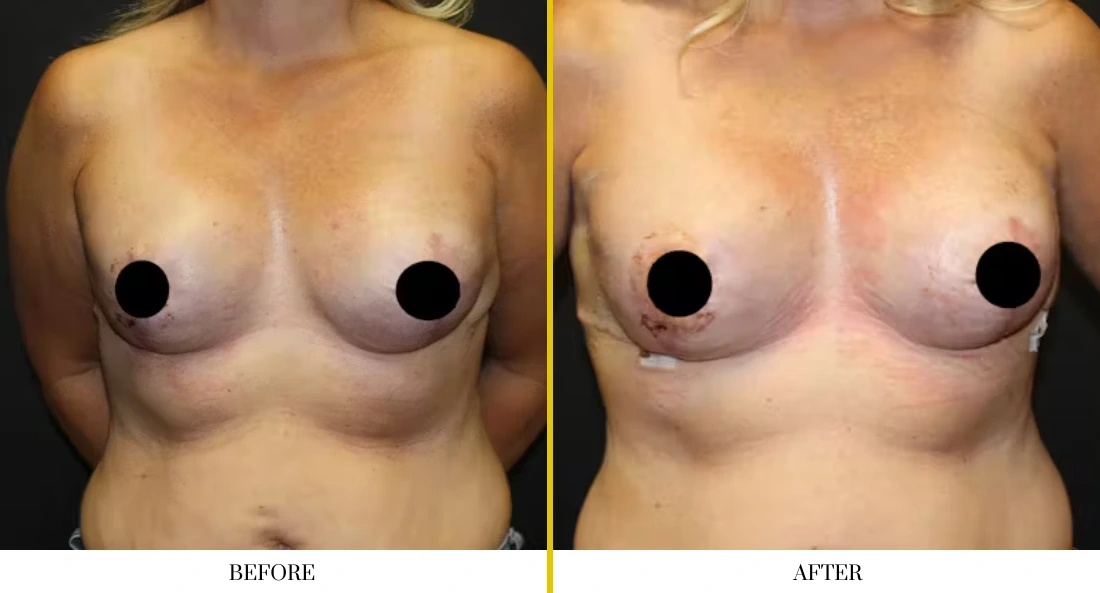 BREAST RECONSTRUCTION (19)
