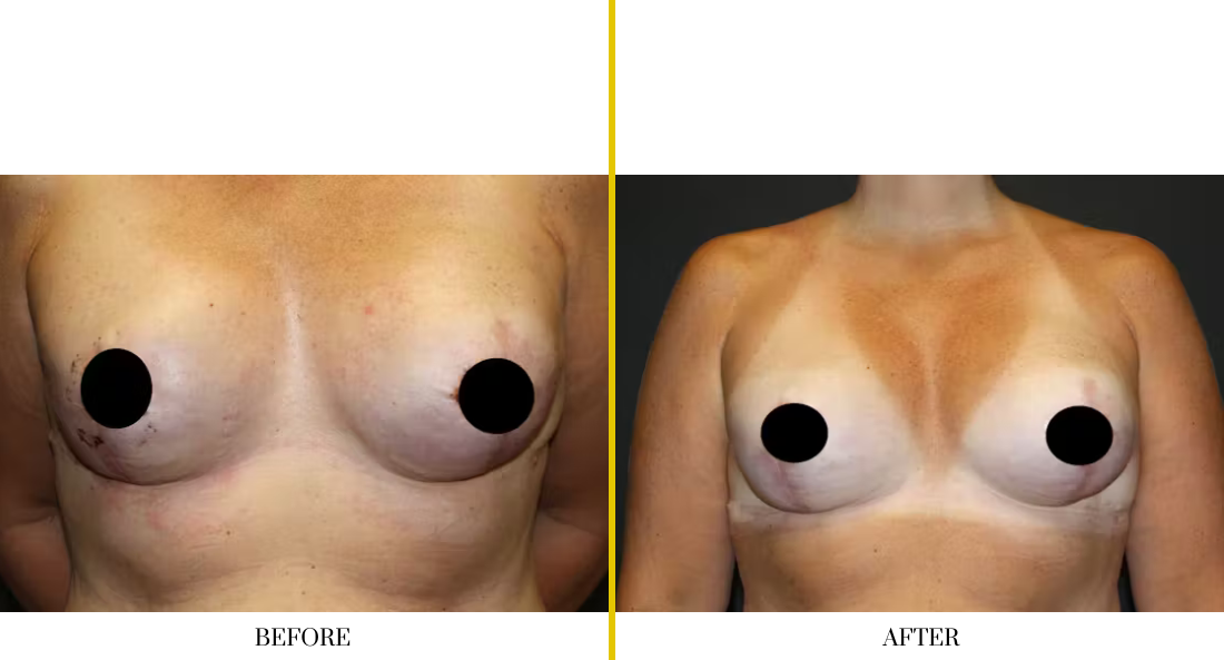 BREAST RECONSTRUCTION (20)
