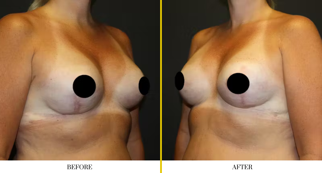 BREAST RECONSTRUCTION (21)