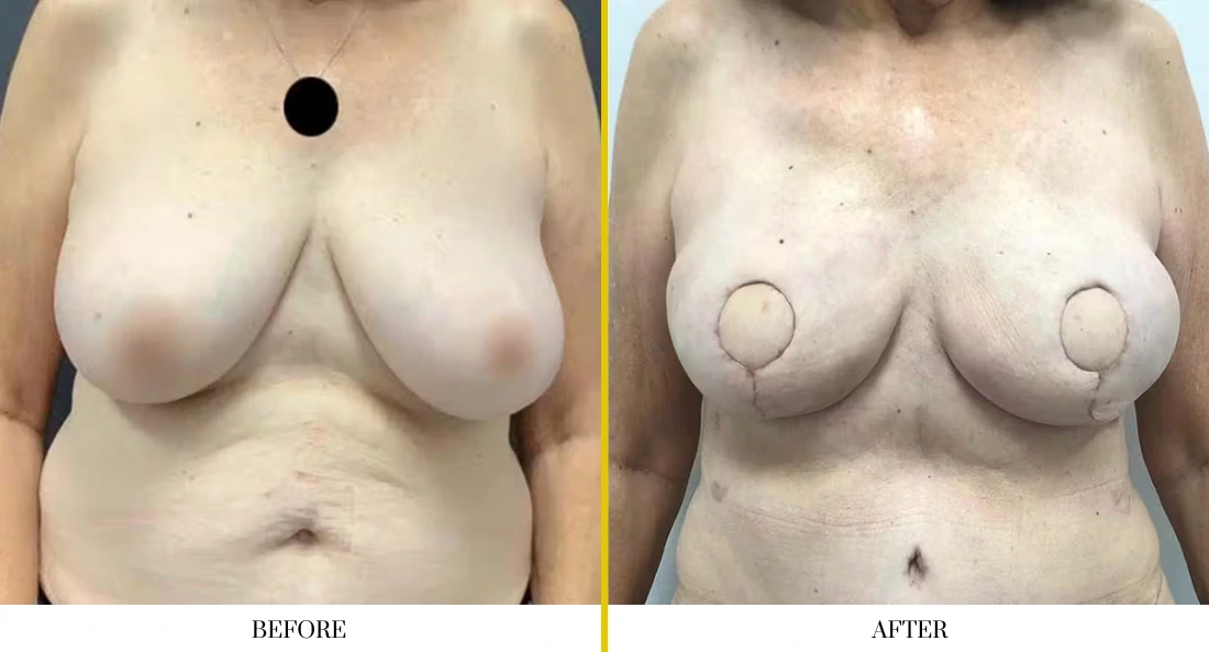BREAST RECONSTRUCTION (3)