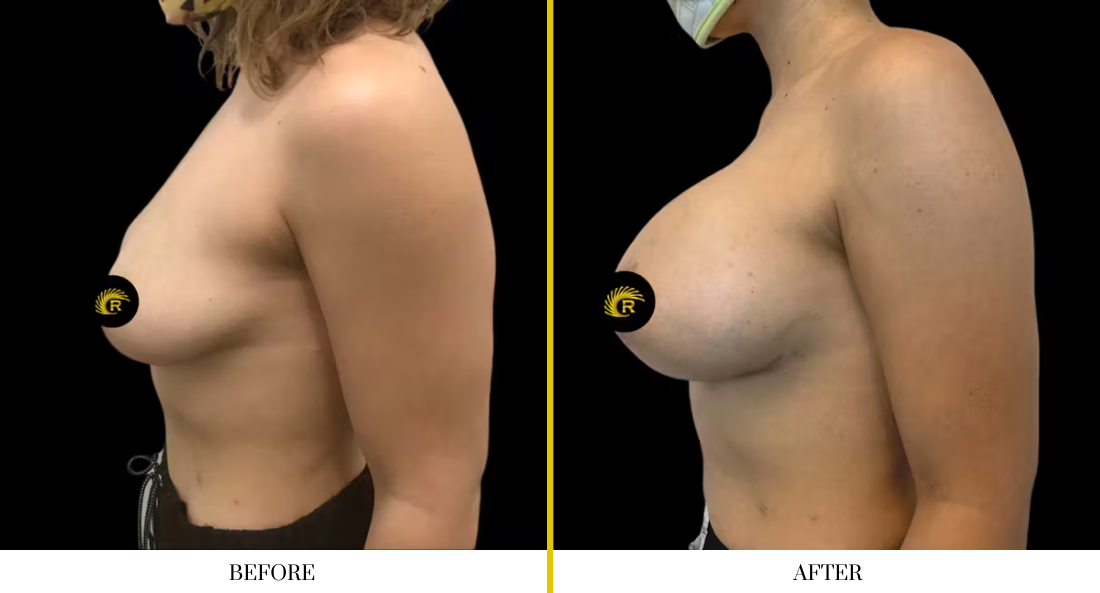 BREAST RECONSTRUCTION (5)