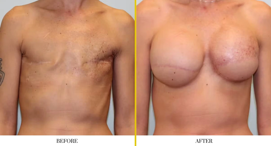 BREAST RECONSTRUCTION (8)