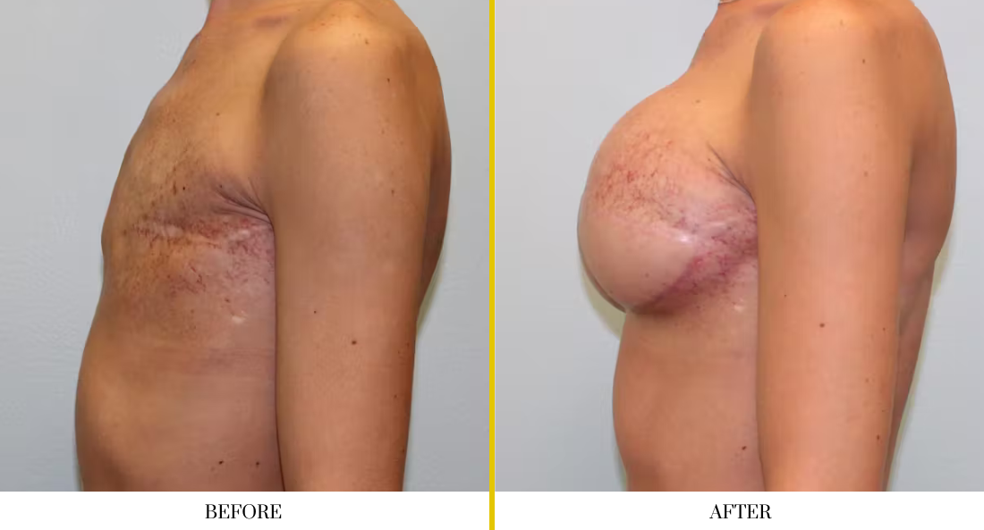 BREAST RECONSTRUCTION (9)