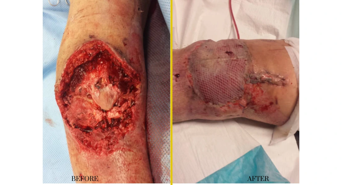 Extremity Reconstruction (26)