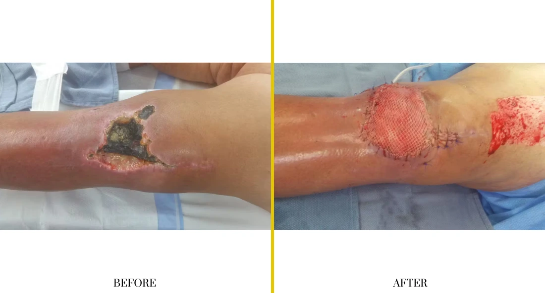 Extremity Reconstruction (27)