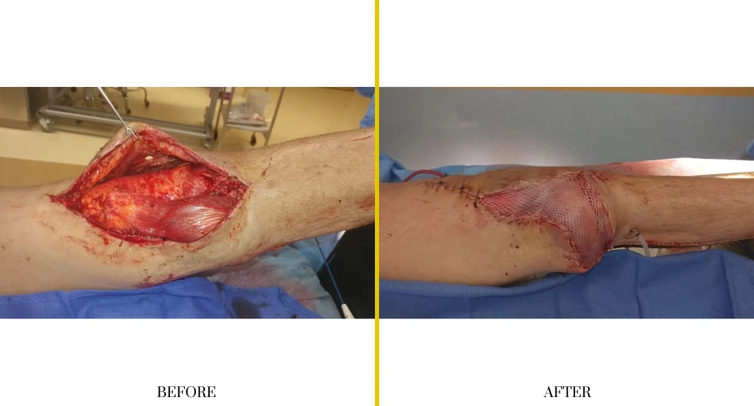 Extremity Reconstruction (29)