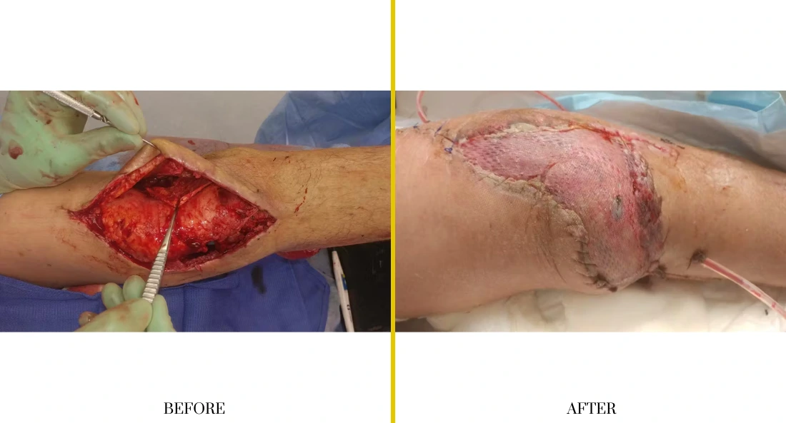 Extremity Reconstruction (30)