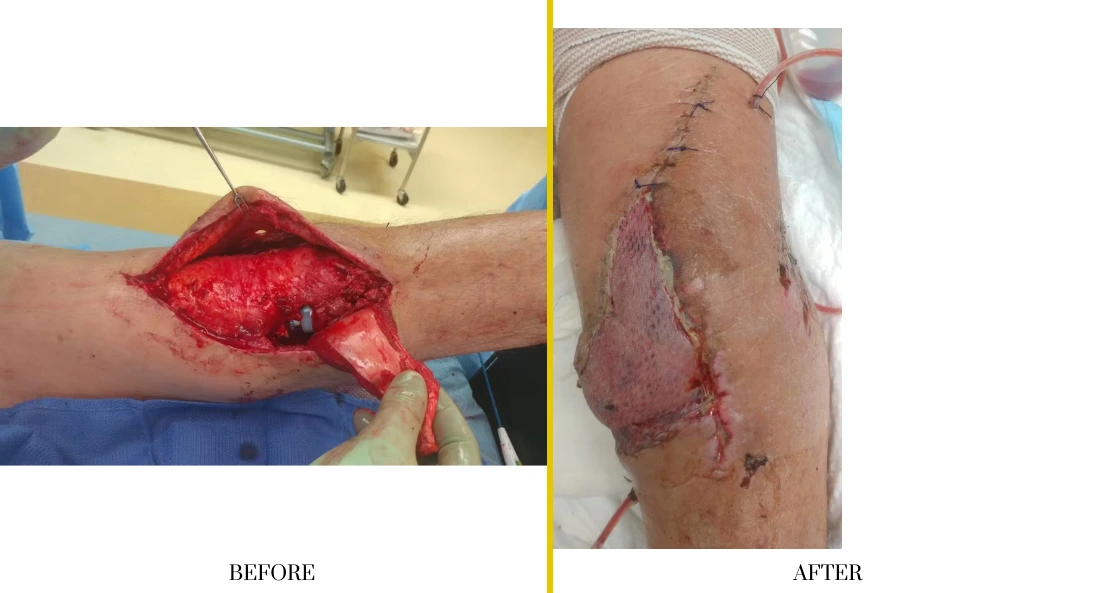 Extremity Reconstruction (31)
