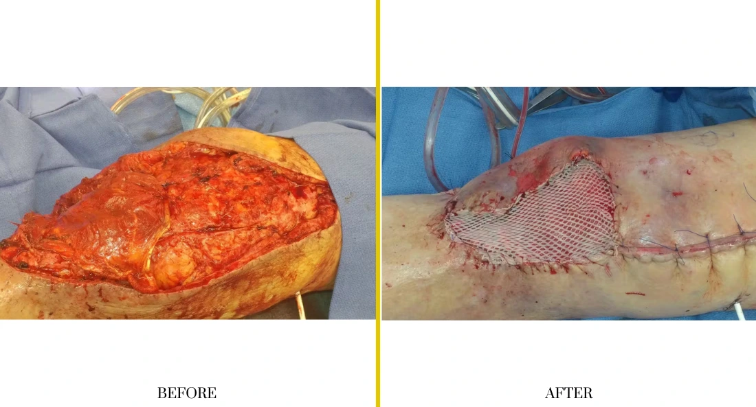 Extremity Reconstruction (32)
