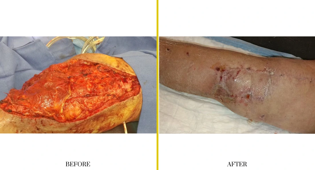 Extremity Reconstruction (33)