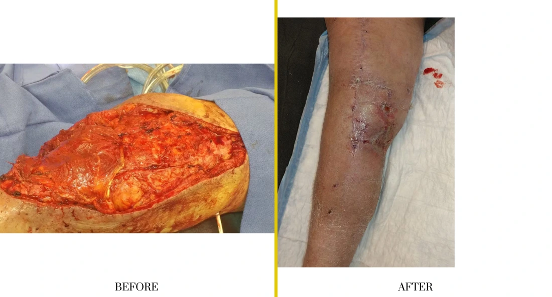 Extremity Reconstruction (34)