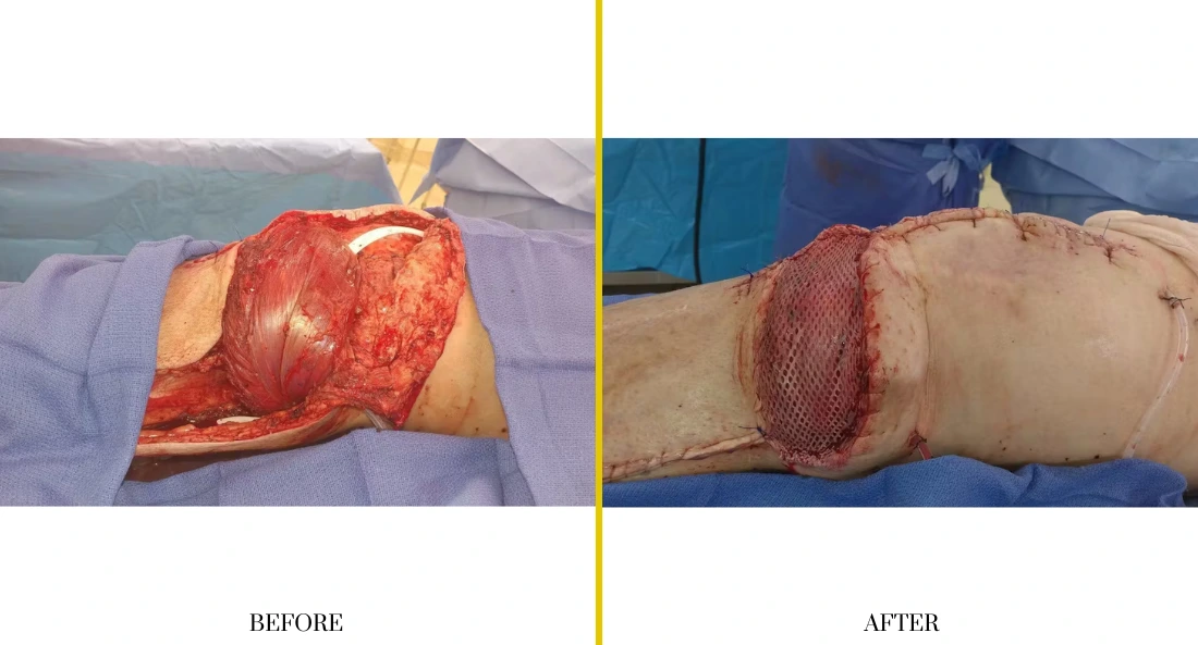 Extremity Reconstruction (36)