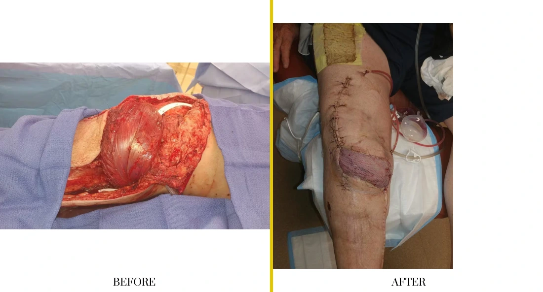 Extremity Reconstruction (37)