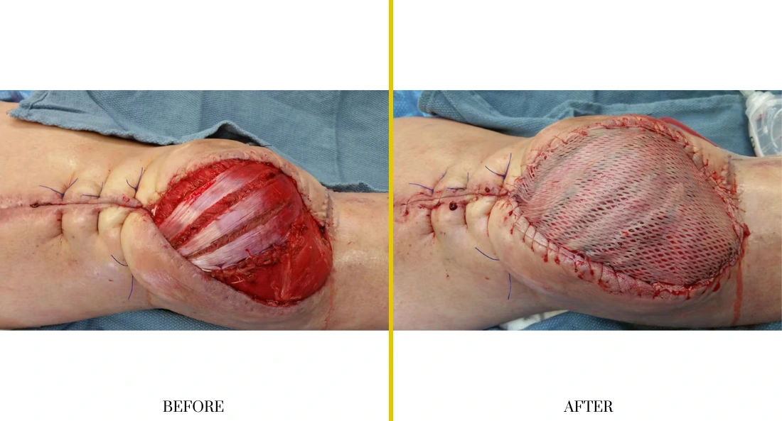 Extremity Reconstruction (38)