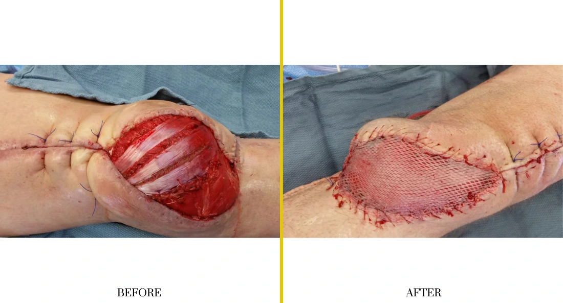 Extremity Reconstruction (39)