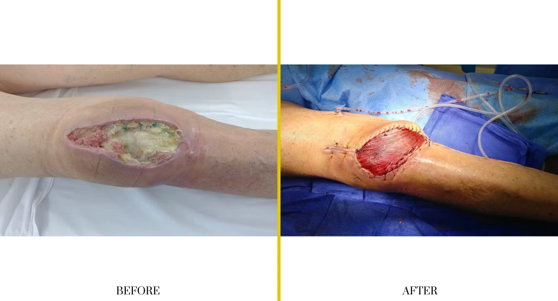 Extremity Reconstruction (46)