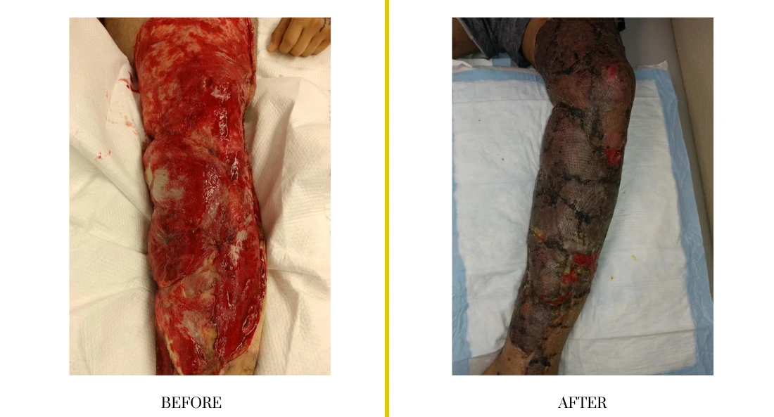 Extremity Reconstruction (49)