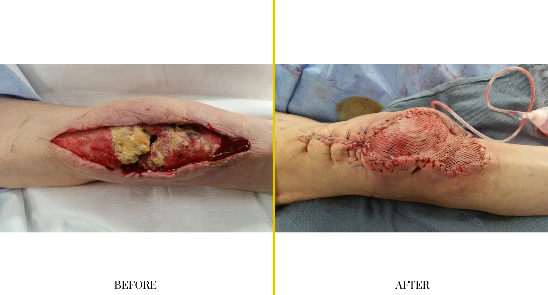 Extremity Reconstruction (50)