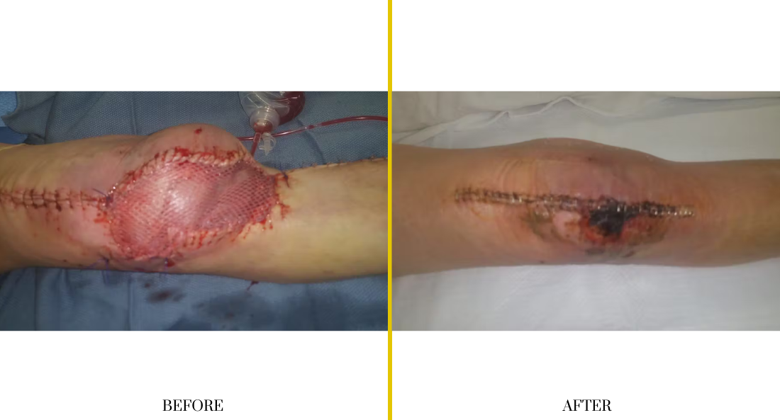 Extremity Reconstruction (57)