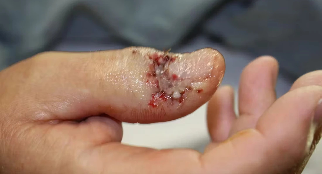 Extremity Reconstruction (60)