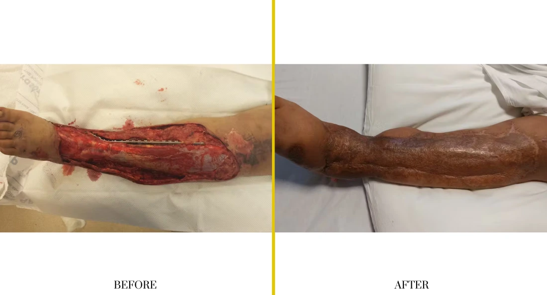 Extremity Reconstruction (61)
