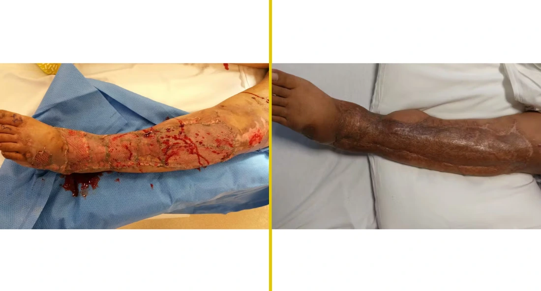 Extremity Reconstruction (62)