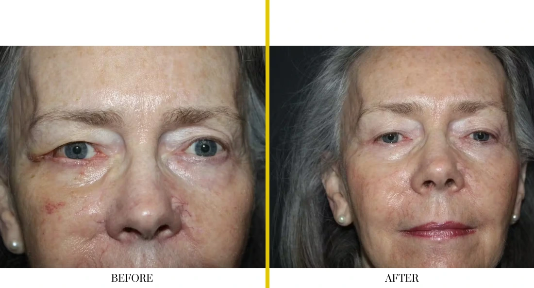 Facial (2)