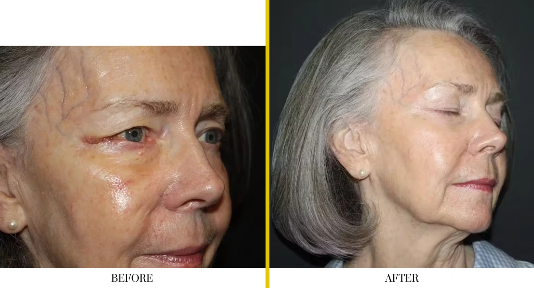 Facial (3)