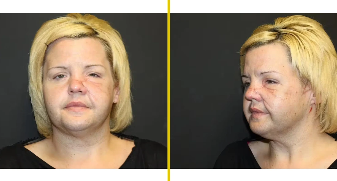 Facial (39)