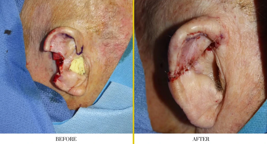 Facial and MOHS Reconstruction 4.1