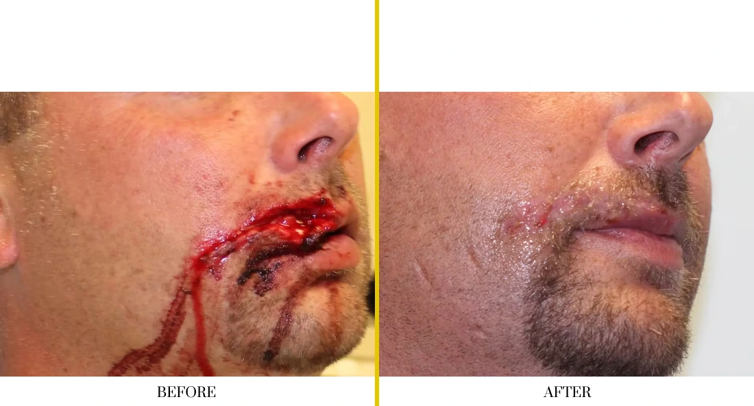 Facial and MOHS Reconstruction 5.1