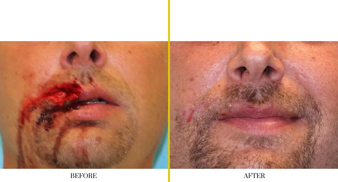 Facial and MOHS Reconstruction 5.2