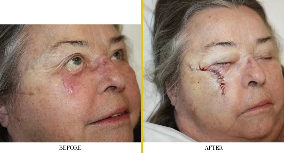 Facial