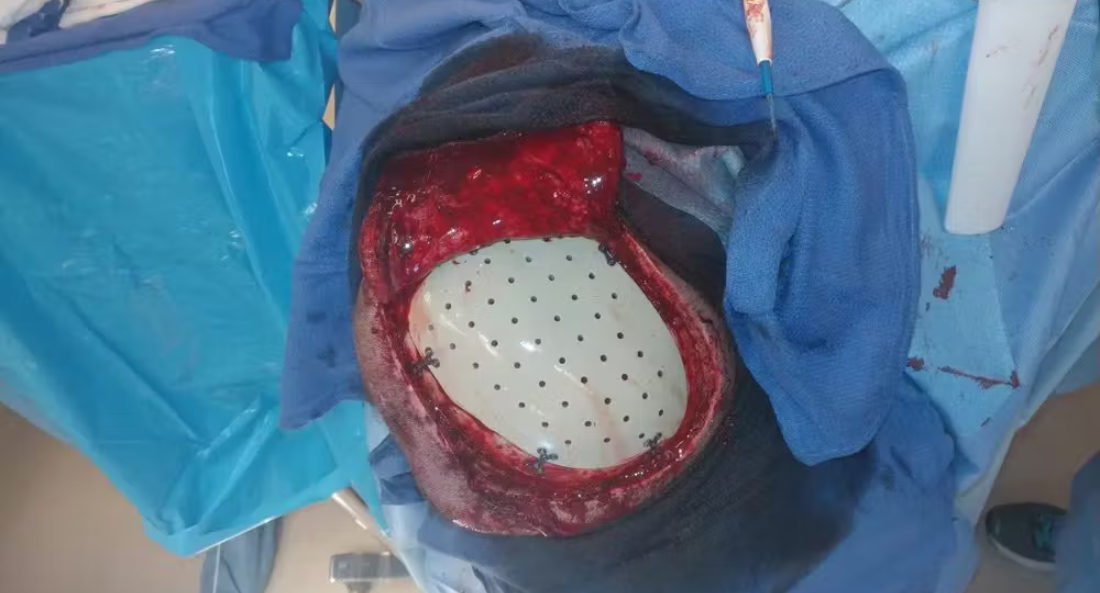 Skull Reconstruction and Cranioplasty (10)