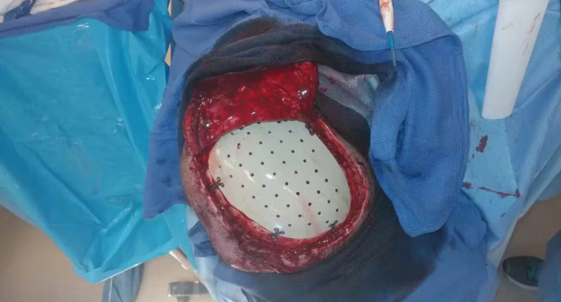 Skull Reconstruction and Cranioplasty (10)