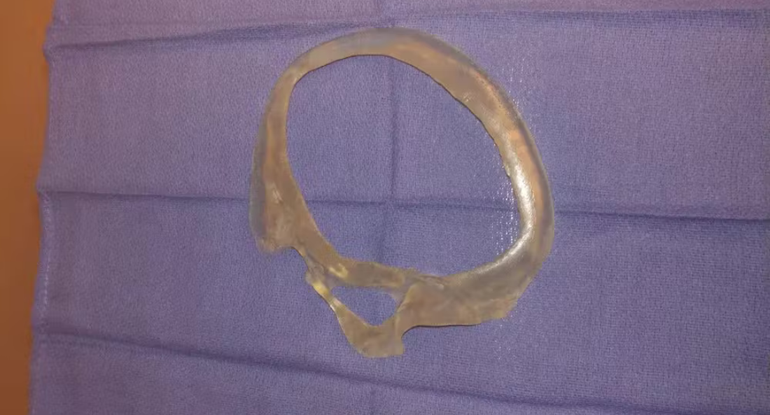 Skull Reconstruction and Cranioplasty (11)
