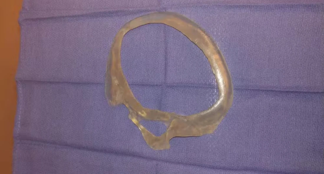 Skull Reconstruction and Cranioplasty (11)